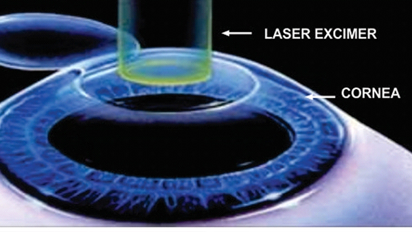 cirugia-lasik