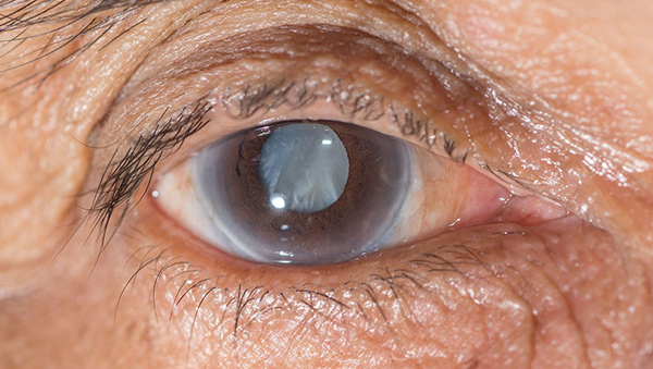 glaucoma
